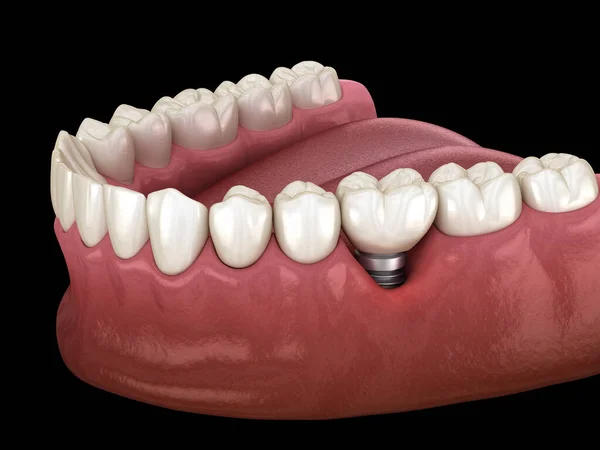 目に見える歯茎の後退を有するPeri Implantitis 歯科インプラントの概念の医学的に正確な3Dイラスト — ストック写真
