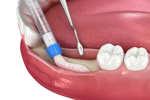 Aumento Enxertia Óssea Para Implante Dentário Ilustração Medicamente Precisa — Fotografia de Stock