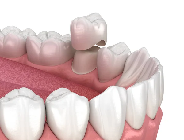 Colocación Dientes Premolares Corona Dental Preparada Ilustración Médicamente Precisa —  Fotos de Stock