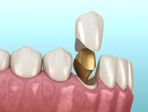 Gouden Stomp Pin Tab Canaine Tand Medisch Nauwkeurige Tandheelkundige Illustratie — Stockfoto