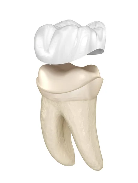 Posizionamento Corona Porcellana Sopra Dente Molare Illustrazione Clinicamente Accurata — Foto Stock