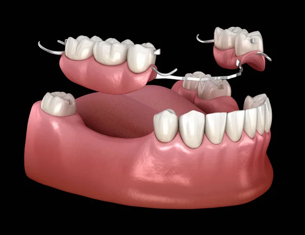 Αφαιρούμενη Μερική Οδοντοστοιχία Πρόσθεση Κάτω Γνάθου Ιατρικά Ακριβής Τρισδιάστατη Απεικόνιση — Φωτογραφία Αρχείου