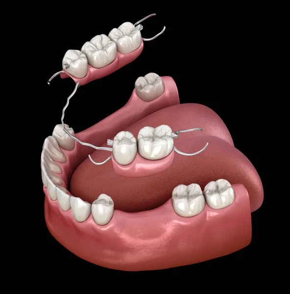 Prothèse Partielle Amovible Prothèse Mandibulaire Illustration Médicalement Précise Concept Prosthodontie — Photo
