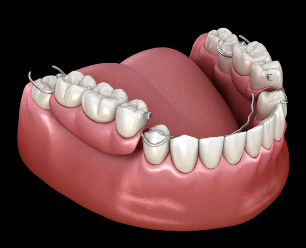 可摘除的局部假牙下颌骨假牙假牙概念的医学上准确的3D说明 — 图库照片