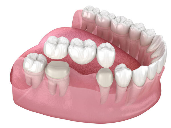 Стоматологический мост из 3 зубов через коренной и премоляр. Медицинская точность 3D иллюстрации лечения человеческих зубов
