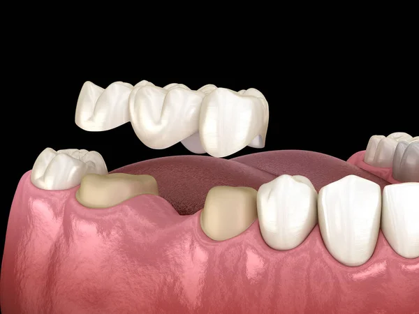 Стоматологічний Міст Трьох Зубів Над Молярним Премолярним Медично Точна Ілюстрація — стокове фото