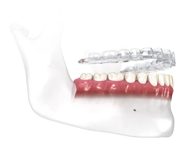Bite Splint Προστασία Του Βρουξισμού Ιατρικά Ακριβής Οδοντιατρική Τρισδιάστατη Απεικόνιση — Φωτογραφία Αρχείου