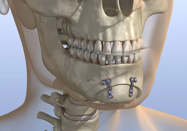 リダクション 浸透圧形成術 医学的に正確な歯科3Dイラスト — ストック写真