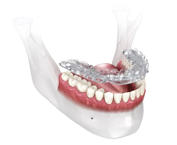 Isırık Kıymığı Bruksizm Koruması Tıbbi Olarak Doğru Olan Boyutlu Diş — Stok fotoğraf