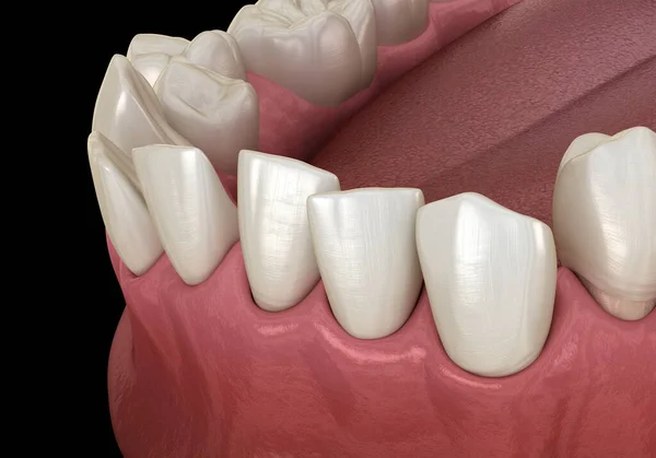 Overcrowded teeth, abnormal dental occlusion. Medically accurate tooth 3D illustration