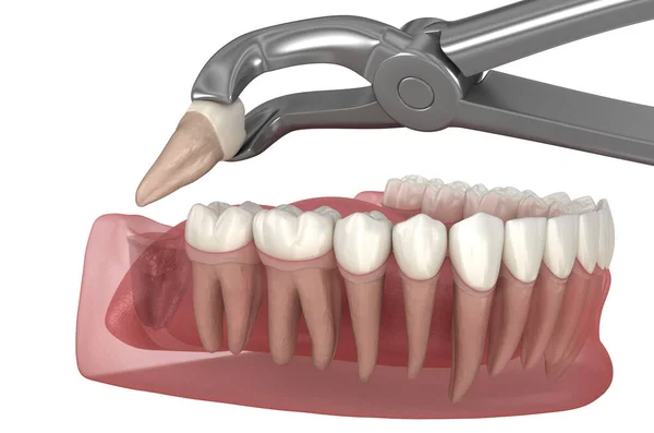 知恵の歯の抽出 医学的に正確な歯3Dイラスト — ストック写真