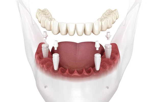 すべてのセラミックインプラントによってサポートされている4システム上の歯科補綴物 医学的に正確な3Dイラスト — ストック写真