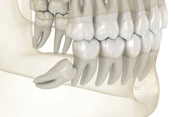 知恵の歯の重要な影響 医学的に正確な歯3Dイラスト — ストック写真