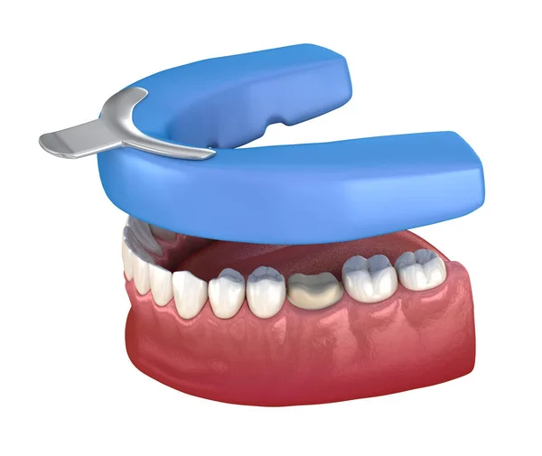 Zahnärztlicher Eindruck Behandlungsplanung Medizinisch Korrekte Darstellung Der Zähne lizenzfreie Stockbilder