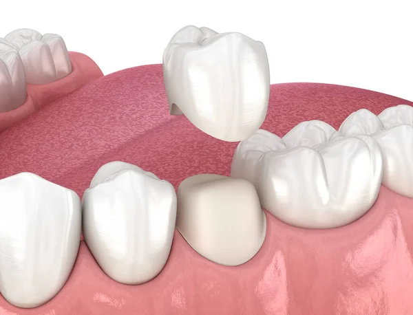 Preparado Dente Pré Molar Colocação Coroa Dental Ilustração Medicamente Precisa Fotos De Bancos De Imagens