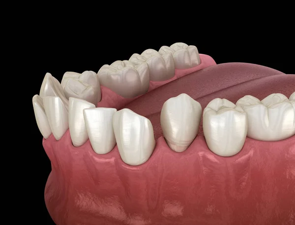 Переполненные Зубы Ненормальная Окклюзия Зубов Медицинская Точность Трехмерной Иллюстрации Зубов Стоковое Изображение