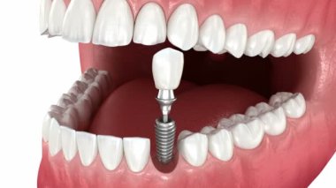 Diş implantı ve seramik taç yerleştirme. Tıbbi olarak doğru diş 3D animasyonu