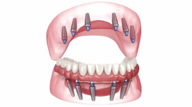 Protezler 6 implantla destekleniyor. Diş 3B canlandırması