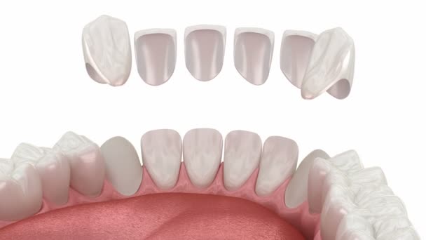 Tandfasad Placering Förfarande Animering För Tandläkare — Stockvideo