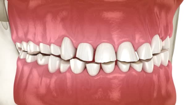 Zubní Implantace Bruxismus Vedoucí Ztrátě Zubní Tkáně Animace Zubů — Stock video