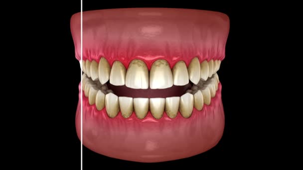 Tandblekning Före Och Efter Rengöring Animering För Tandläkare — Stockvideo
