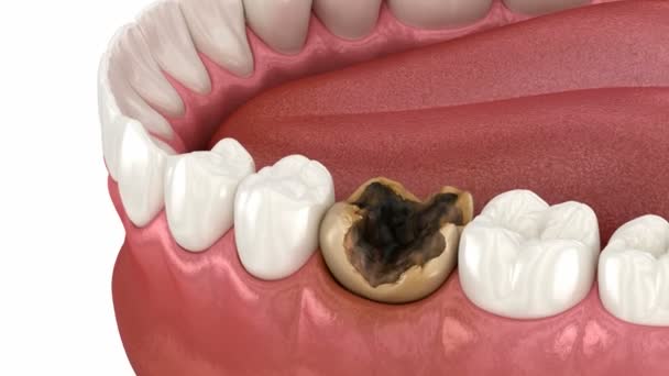 損傷した歯の抽出 デンタル3Dアニメーション — ストック動画