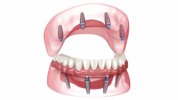 Prótesis Soportadas Por Implantes Animación Dental — Vídeo de stock
