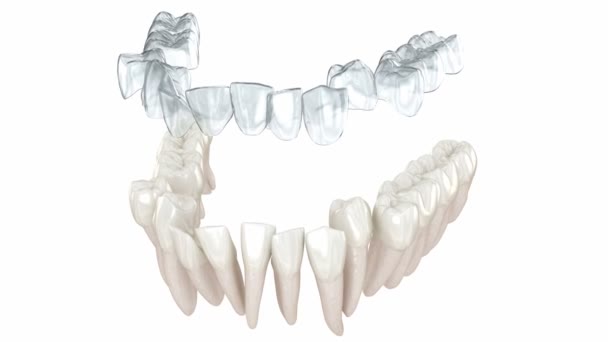 Diş Telleri Görünmez Diş Telleri Isırık Düzeltmesini Sağlar Boyutlu Canlandırma — Stok video