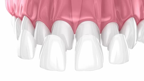 中央および横の切開剤の上の歯科ベニヤの配置 3Dアニメーション — ストック動画