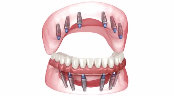 Prothesen Die Von Implantaten Unterstützt Werden Zahnärztliche Animation — Stockvideo