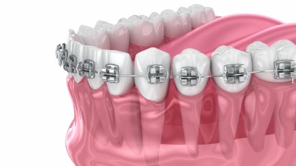Cuspid Korrektur Mit Zahnspange Medizinisch Genaue Zahnärztliche Animation — Stockvideo