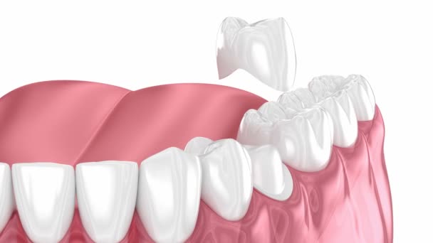 Przygotowany Ząb Przedtrzonowy Umieszczenie Korony Dentystycznej Animacja Stomatologiczna — Wideo stockowe