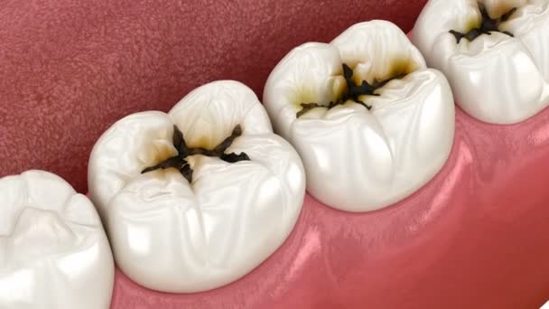 Molaire Tanden Beschadigd Door Cariës Medisch Nauwkeurige Tand Animatie — Stockvideo