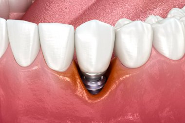 Peri-implantit ve gözle görülür gingiva durgunluğu. Tıbbi olarak doğru 3B illüstrasyon.