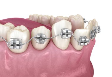 Anormal diş pozisyonu ve metal diş telleriyle düzeltme. Tıbbi olarak doğru olan 3 boyutlu diş illüstrasyonu