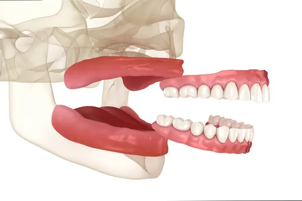 Prótese Removível Gengiva Artificial Dentes Ilustração Dental — Fotografia de Stock