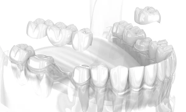 Zubní Keramická Koruna Zubní Můstek Umístění Lékařsky Přesná Ilustrace — Stock fotografie