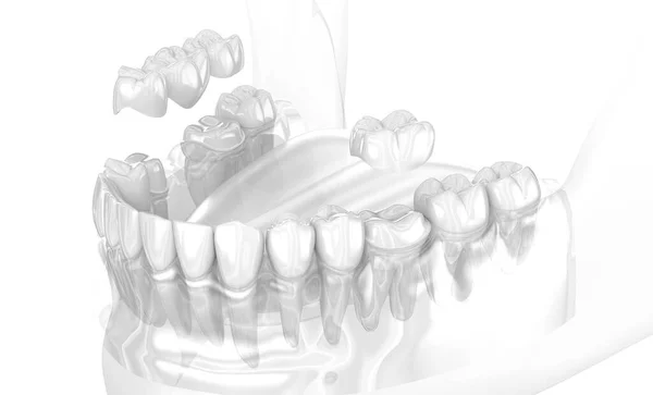 牙科陶瓷冠和牙桥放置 医学上准确的3D图像 — 图库照片