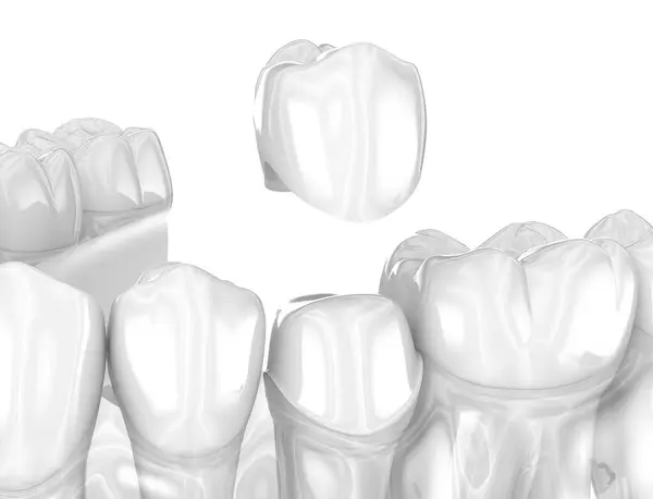 Colocação Coroa Cerâmica Dental Ilustração Medicamente Precisa — Fotografia de Stock