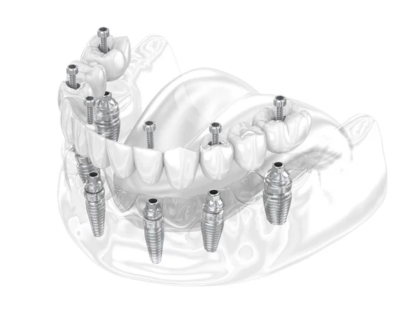Prótese Dentária Suportada Por Seis Implantes Ilustração Dental — Fotografia de Stock