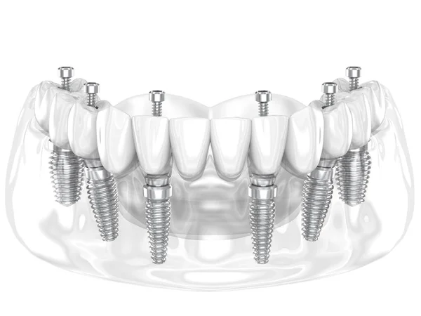 Prótese Dentária Suportada Por Seis Implantes Ilustração Dental — Fotografia de Stock