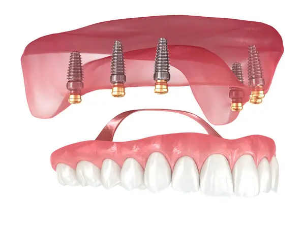 Protesi Rimovibile Basata Sei Impianti Illustrazione Dentale — Foto Stock
