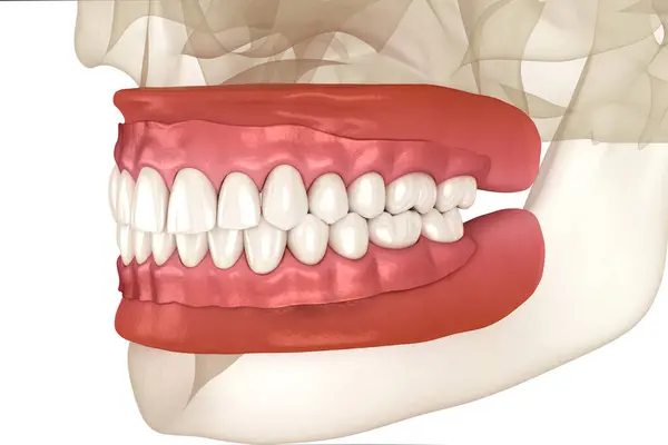 Herausnehmbare Prothese Künstliches Zahnfleisch Und Zähne Zahnärztliche Illustration Stockbild