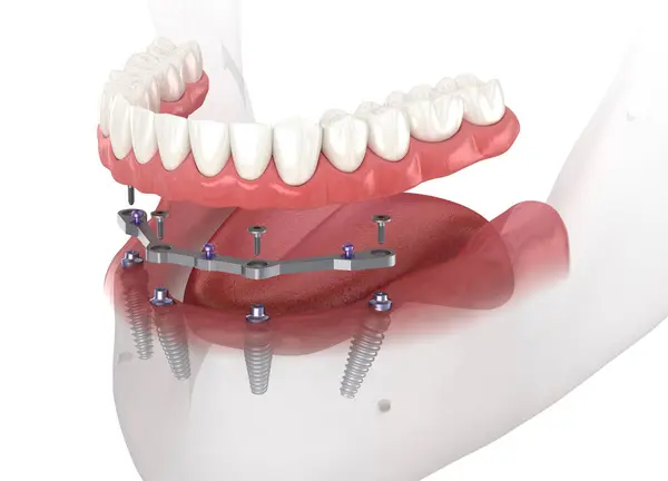 下颌骨假体与牙龈全部在4个系统支持植入物 医学上准确的3D图像 图库图片