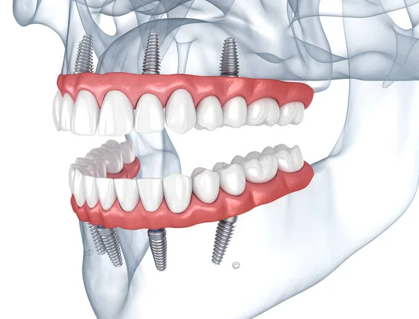 Protézy Podporované Implantáty Zubní Ilustrace Stock Obrázky