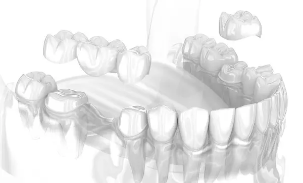 Zahnkeramische Krone Und Zahnüberbrückung Medizinisch Korrekte Darstellung Stockbild