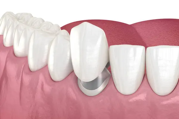 Zahnstumpfnadel Tab Auf Kanarienzahn Medizinisch Korrekte Zahnärztliche Illustration lizenzfreie Stockfotos