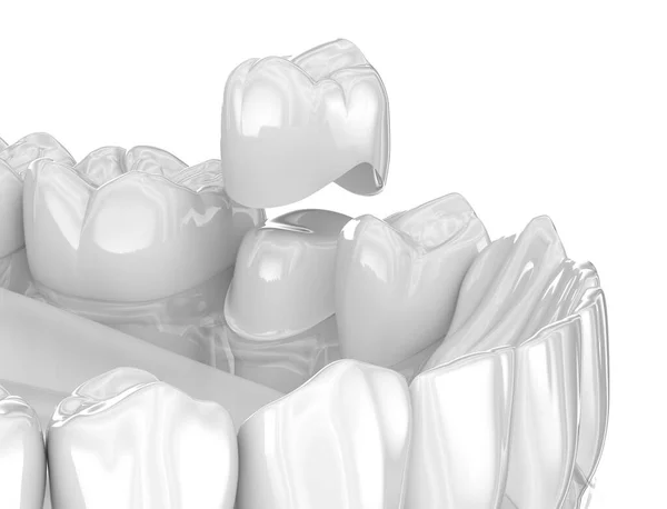 假牙陶瓷冠放置 医学上准确的3D图像 图库照片