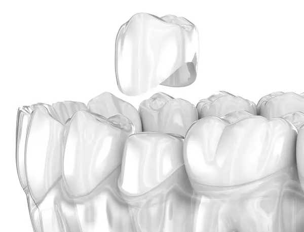 Umístění Zubní Keramické Koruny Lékařsky Přesná Ilustrace Stock Snímky