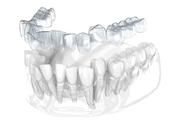 Invisalign Aparat Ortodontyczny Lub Niewidzialny Aparat Ortodontyczny Dokonać Korekty Ugryzień Zdjęcie Stockowe